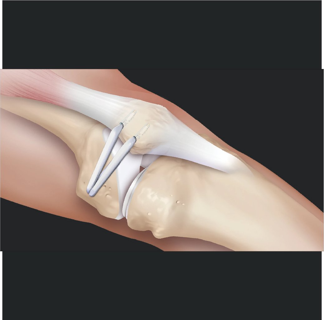 Management Unstable Patella